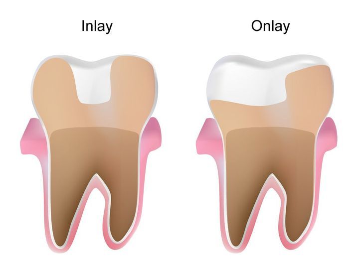 How are Inlays Different from Onlays and What are they Used for in Dentistry?