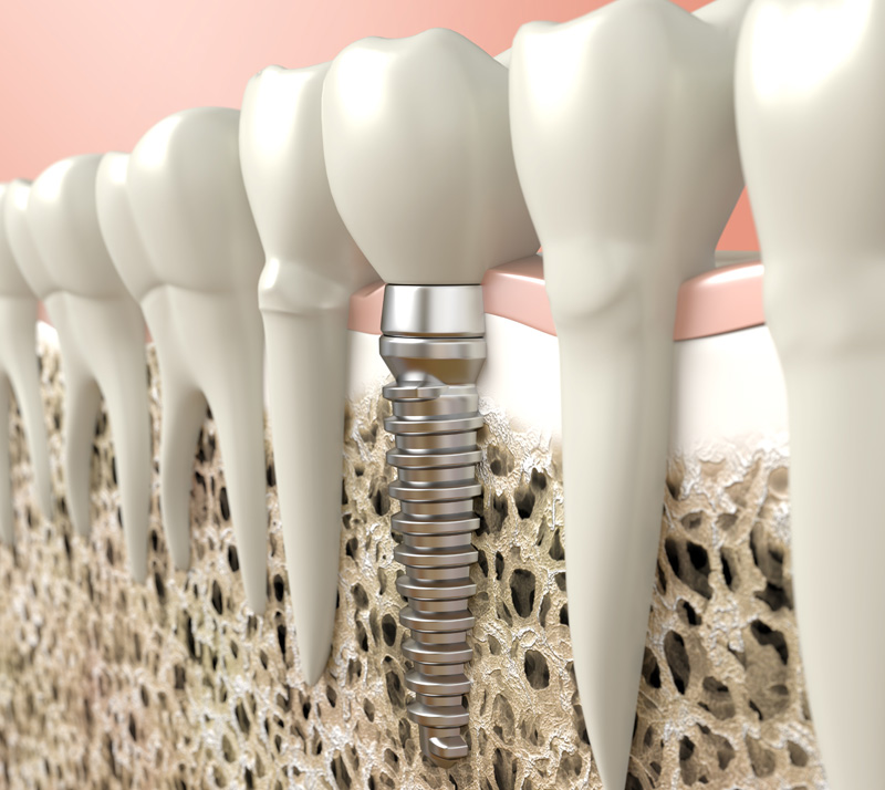 dental implants in langley
