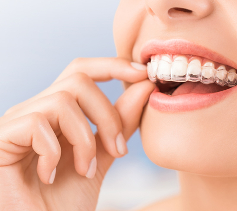 Invisalign vs Braces – Langley Family Dentistry